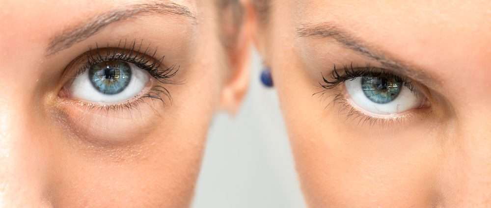 Tear Trough Fillers Before and After